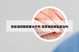 銀屑病初期需要治療嗎 銀屑病初期能根治嗎