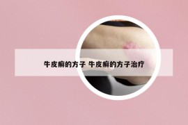 牛皮癬的方子 牛皮癬的方子治療