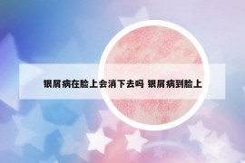 銀屑病在臉上會消下去嗎 銀屑病到臉上