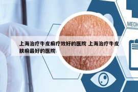 上海治療牛皮癬療效好的醫(yī)院 上海治療牛皮膚癬最好的醫(yī)院