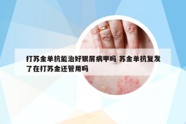 打蘇金單抗能治好銀屑病甲嗎 蘇金單抗復(fù)發(fā)了在打蘇金還管用嗎