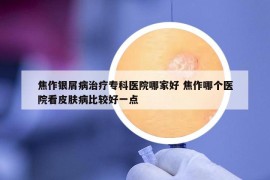 焦作銀屑病治療?？漆t(yī)院哪家好 焦作哪個醫(yī)院看皮膚病比較好一點(diǎn)