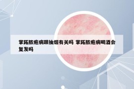 掌跖膿皰病跟抽煙有關嗎 掌跖膿皰病喝酒會復發(fā)嗎