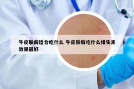 牛皮膚癬適合吃什么 牛皮膚癬吃什么維生素效果最好
