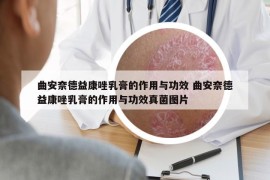 曲安奈德益康唑乳膏的作用與功效 曲安奈德益康唑乳膏的作用與功效真菌圖片