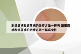 副銀屑病和銀屑病的治療方法一樣嗎 副銀屑病和銀屑病的治療方法一樣嗎女性