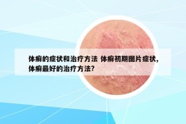 體癬的癥狀和治療方法 體癬初期圖片癥狀,體癬最好的治療方法?
