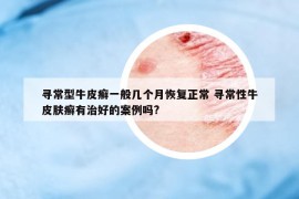尋常型牛皮癬一般幾個月恢復(fù)正常 尋常性牛皮膚癬有治好的案例嗎?