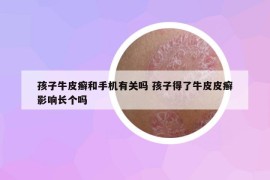 孩子牛皮癬和手機(jī)有關(guān)嗎 孩子得了牛皮皮癬影響長(zhǎng)個(gè)嗎