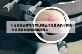 牛皮癬患者懷孕了可以喝治療銀屑病的中藥嗎 銀屑病懷孕期間能用藥膏么