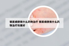 銀屑病使用什么藥物治療 銀屑病使用什么藥物治療效果好