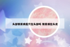 頭部銀屑病是只在頭部嗎 銀屑病在頭皮