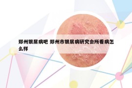 鄭州銀屑病吧 鄭州市銀屑病研究會所看病怎么樣
