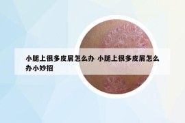 小腿上很多皮屑怎么辦 小腿上很多皮屑怎么辦小妙招