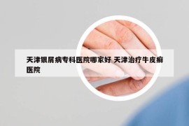 天津銀屑病專科醫(yī)院哪家好 天津治療牛皮癬醫(yī)院