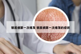 銀屑病第一次爆發(fā) 銀屑病第一次爆發(fā)的癥狀