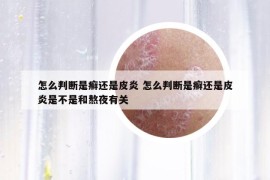 怎么判斷是癬還是皮炎 怎么判斷是癬還是皮炎是不是和熬夜有關(guān)