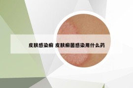 皮膚感染癬 皮膚癬菌感染用什么藥