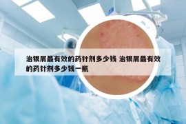 治銀屑最有效的藥針劑多少錢 治銀屑最有效的藥針劑多少錢一瓶
