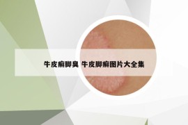 牛皮癬腳臭 牛皮腳癬圖片大全集