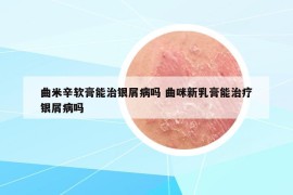 曲米辛軟膏能治銀屑病嗎 曲咪新乳膏能治療銀屑病嗎