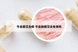 牛皮癬艾灸癢 牛皮膚癬艾灸有用嗎