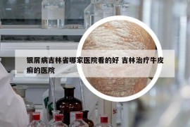 銀屑病吉林省哪家醫(yī)院看的好 吉林治療牛皮癬的醫(yī)院