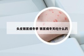 頭皮銀屑病冬季 銀屑病冬天吃什么藥