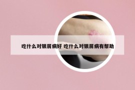 吃什么對銀屑病好 吃什么對銀屑病有幫助