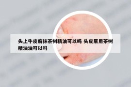 頭上牛皮癬抹茶樹精油可以嗎 頭皮屑用茶樹精油油可以嗎