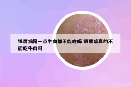 銀屑病是一點(diǎn)牛肉都不能吃嗎 銀屑病真的不能吃牛肉嗎