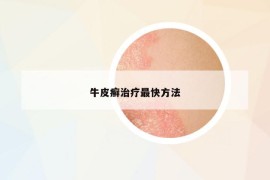 牛皮癬治療最快方法