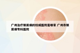 廣州治療銀屑病的權(quán)威醫(yī)院是哪家 廣州市銀屑病專科醫(yī)院