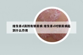 維生素d滴劑有銀屑病 維生素d對銀屑病起到什么作用