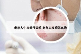 老年人牛皮癬傳染嗎 老年人皮癬怎么治