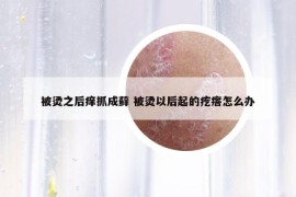 被燙之后癢抓成蘚 被燙以后起的疙瘩怎么辦
