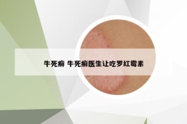 牛死癬 牛死癬醫(yī)生讓吃羅紅霉素