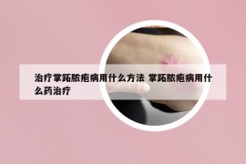 治療掌跖膿皰病用什么方法 掌跖膿皰病用什么藥治療