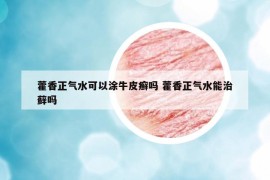 藿香正氣水可以涂牛皮癬嗎 藿香正氣水能治蘚嗎