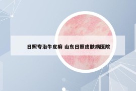 日照專治牛皮癬 山東日照皮膚病醫(yī)院