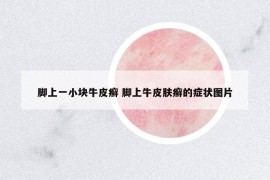 腳上一小塊牛皮癬 腳上牛皮膚癬的癥狀圖片