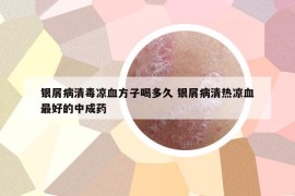 銀屑病清毒涼血方子喝多久 銀屑病清熱涼血最好的中成藥