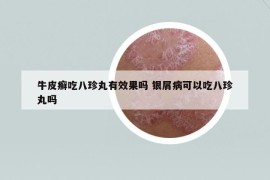 牛皮癬吃八珍丸有效果嗎 銀屑病可以吃八珍丸嗎