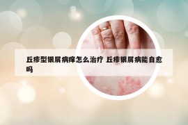 丘疹型銀屑病癢怎么治療 丘疹銀屑病能自愈嗎