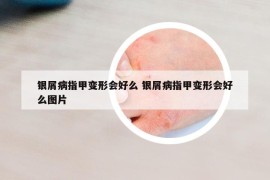 銀屑病指甲變形會好么 銀屑病指甲變形會好么圖片