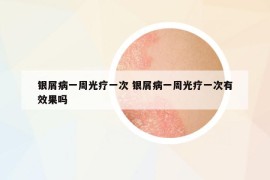 銀屑病一周光療一次 銀屑病一周光療一次有效果嗎