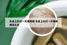 頭皮上紅紅一片銀屑病 頭皮上紅紅一片銀屑病怎么辦