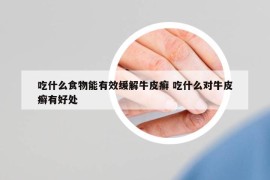 吃什么食物能有效緩解牛皮癬 吃什么對牛皮癬有好處