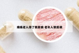 癱瘓老人得了銀屑病 老年人銀屑病