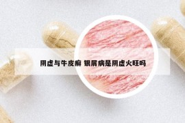 陰虛與牛皮癬 銀屑病是陰虛火旺嗎